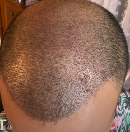 Hair transplant 10 days after surgery