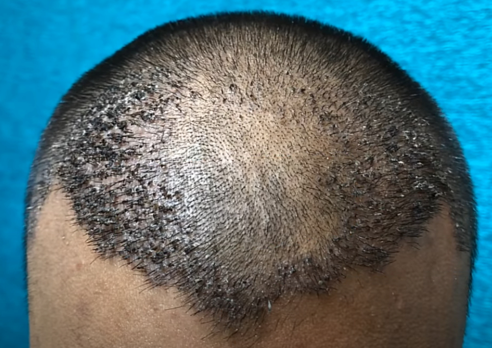 scalp 10 days post hair transplantation