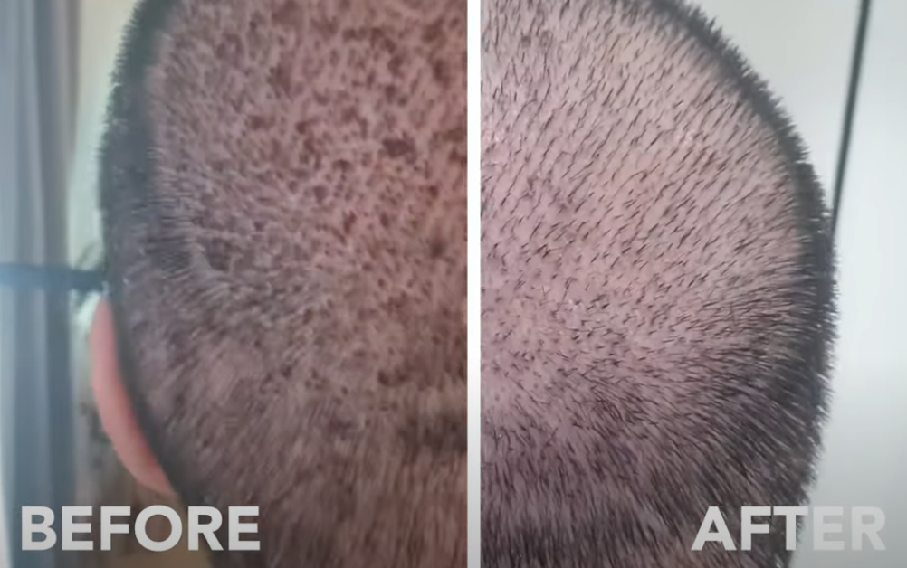 Scabs on scalp before and after washing hair 10 days post-transplant