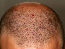 scalp folliculitis