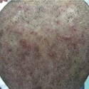 Scalp Folliculitis According To The NHS: Causes & Treatments