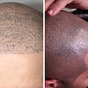 8 Scalp Micropigmentation Regrets And How To Avoid Them