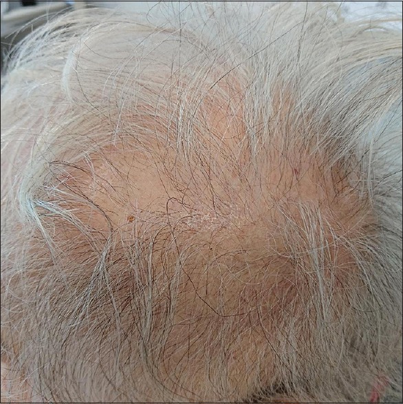 Scalp of patient with trichodynia and depression