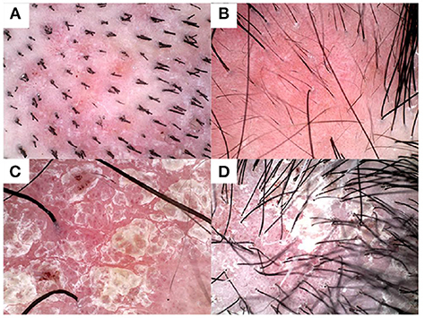 up-close images of psoriasis on the scalp