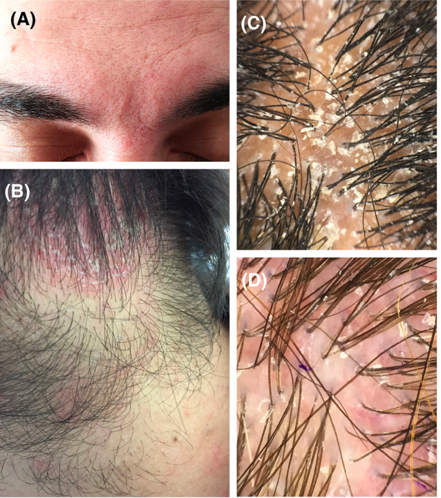 8 Common Scalp Problems Photos Causes Treatments