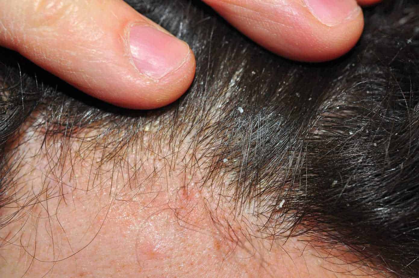 scalp psoriasis and tinnitus