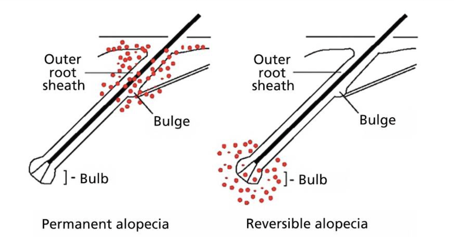 Inflammation of the hair follicle in scarring and non-scarring alopecia