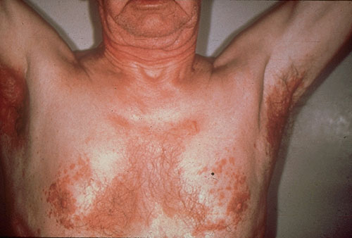 seborrheic dermatitis on the chest