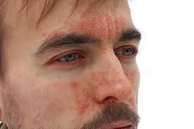 seborrheic dermatitis on the face
