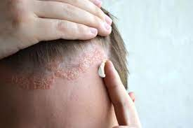 seborrheic dermatitis on the scalp