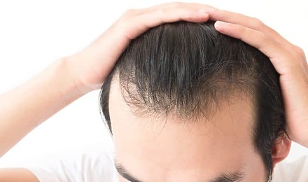 Wimpole Clinic Guide To Thinning Hair