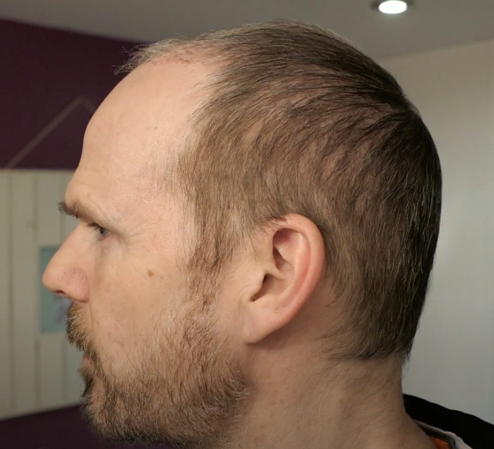 scalp hairs 2 months after hair transplant