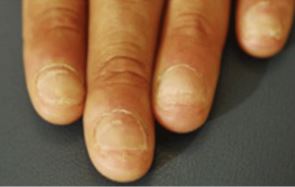 split nails alopecia areata