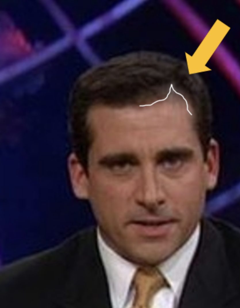 Steve Carell Hair Transplant Everything You Need To Know