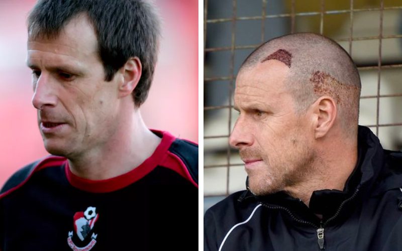Steve Claridge before and after hair transplant surgery