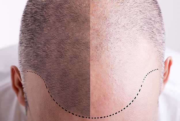 SMP Hair Transplant: Everything You Need To Know