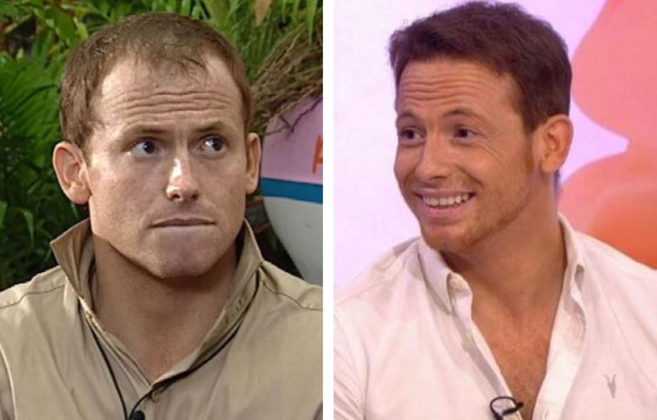joe swash celebrity hair transplant before and after
