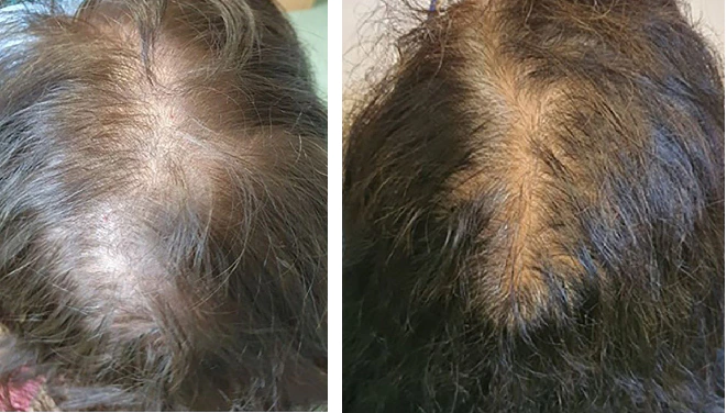 Examples of patients experiencing diffuse hair loss from telogen effluvium