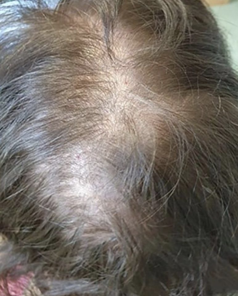 Patient with reduced hair density due to telogen effluvium