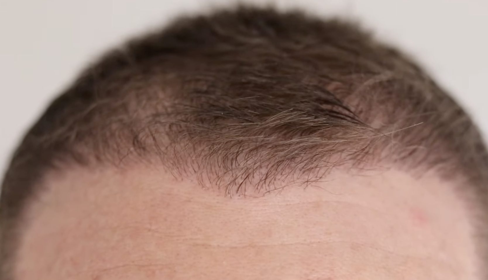 temple close up 4 months after hair transplant