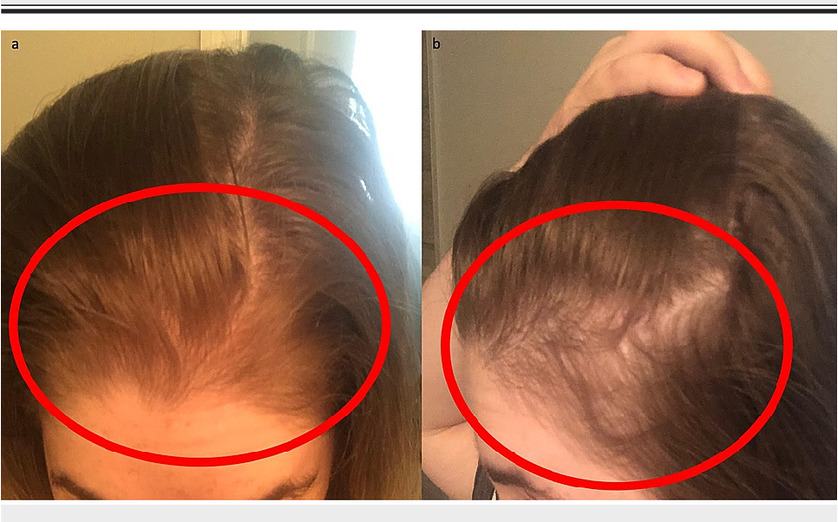 Hair Loss After Surgery Why It Happens & How To Stop It