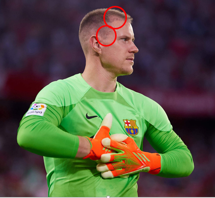 ter Stegen with possible hair grafts on the temples
