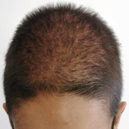 thinning hair in anorexia patient