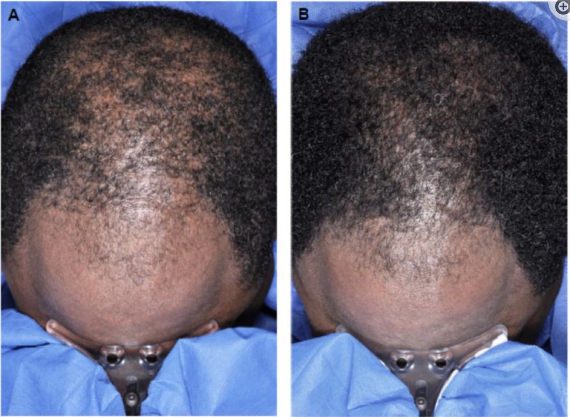 Before and after eight weeks of using 5% Minoxidil foam twice a day