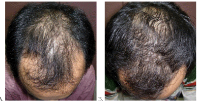 Hair density improvements after one year of oral Finasteride use.