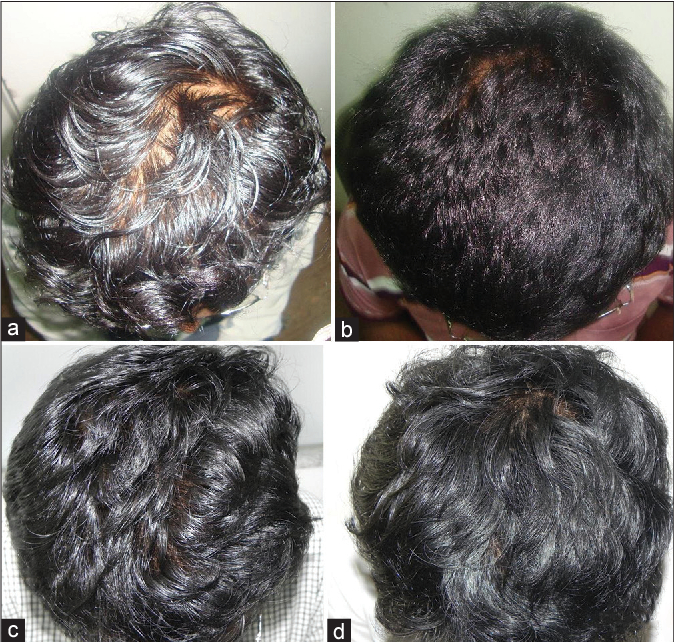 photos showing the improvement in hair density when taking oral Finasteride