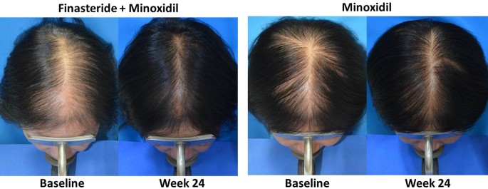 Results of using Finasteride combined with topical Minoxidil for 24 weeks in a female patient with androgenetic alopecia