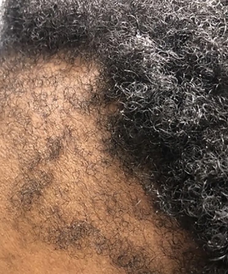 traction alopecia causing one sided hair loss