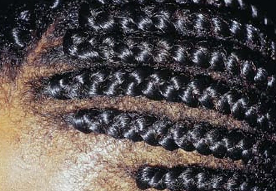 traction alopecia patient early stages