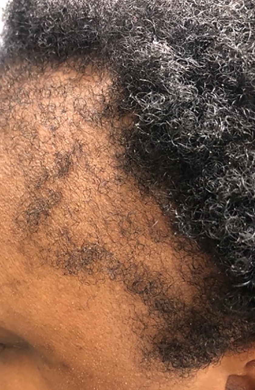Example of front balding caused by a hair loss condition called traction alopecia