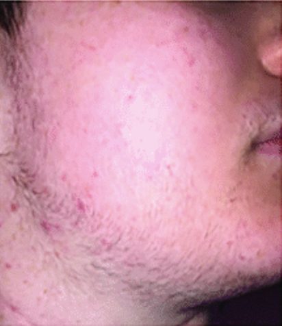 transgender male patient beard 3 months after minoxidil