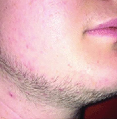 transgender male patient beard 5 months after minoxidil