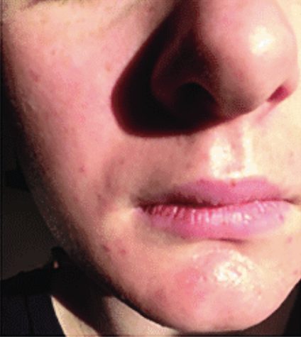 transgender male patient beard before minoxidil