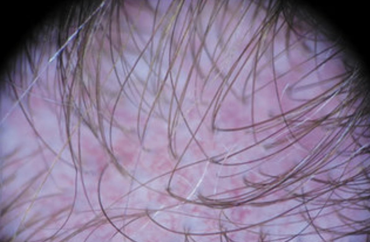 Example of trichodynia on the scalp