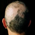 Trichotillomania