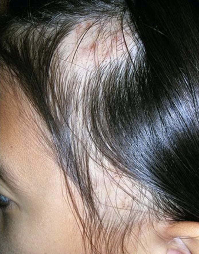 Hair Thinning On One Side of Head - Causes & Solutions – DS