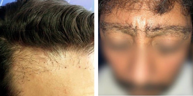 unnatural hair transplant results