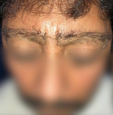 unnatural results - eyebrows - ISHRS