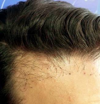 Hair Transplant Gone Wrong? An Expert's Advice On What to Do Next