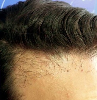 About Infection in Hair Transplant  Estenuvo