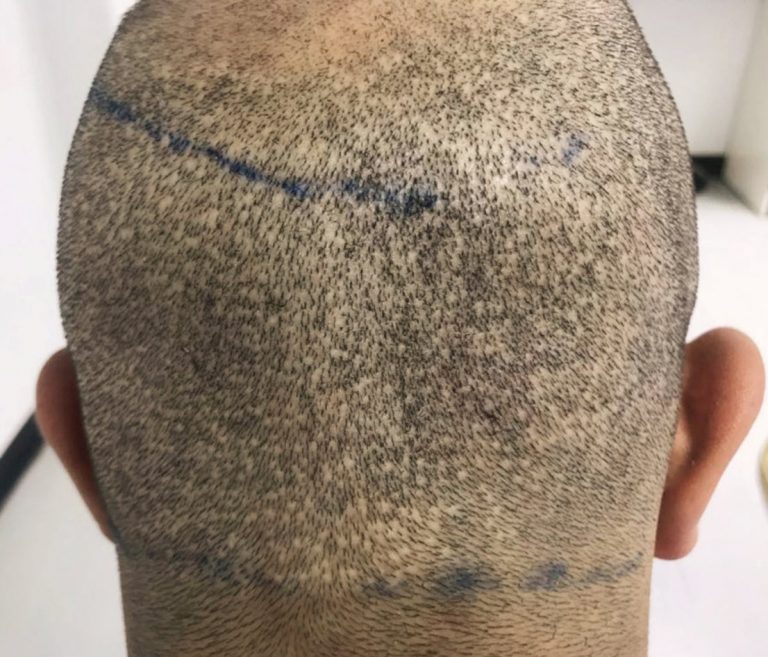 Scar tissue caused by hair transplant gone wrong