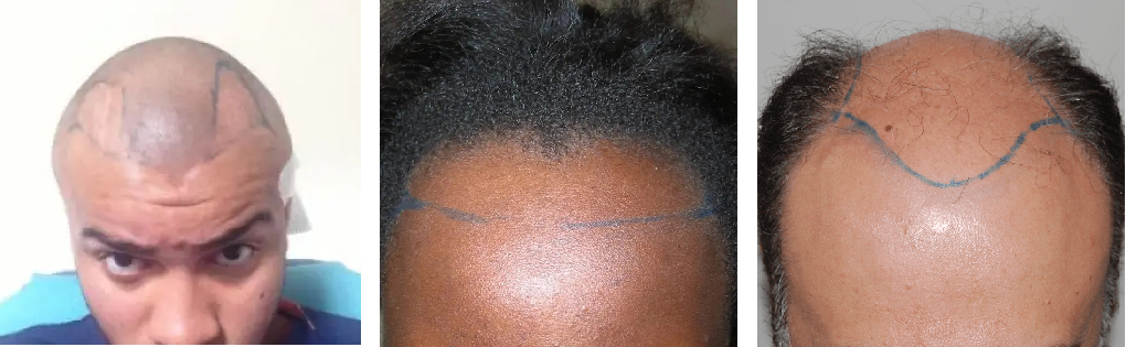 Hairline designs in 3 Wimpole Clinic patients