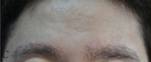 visible scarring on eyebrows
