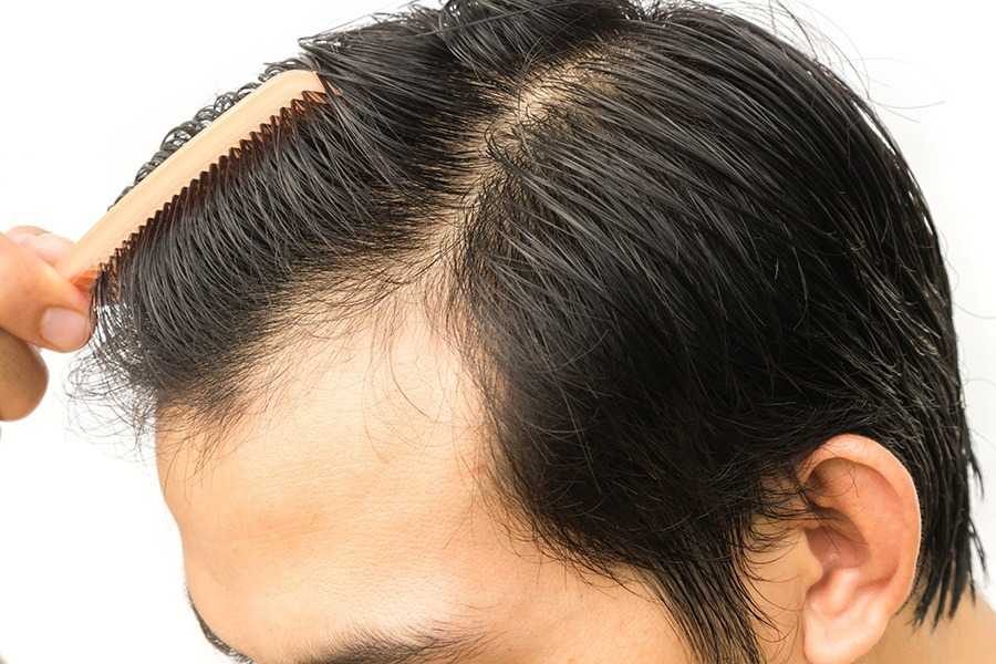 Recovering From Hair-transplant-surgery-what-to-expect