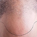 Hair Transplant To Lower Your Hairline