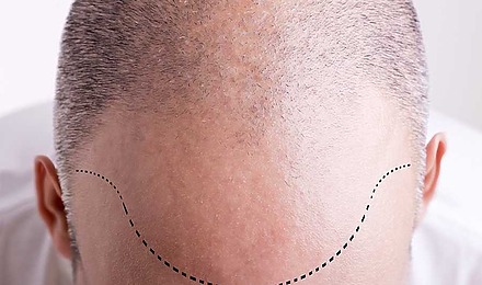 Why Planning Your Hairline Is Essential For Great Transplant Results
